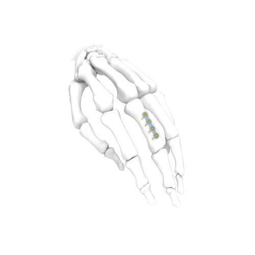 Компрессионная костная пластина для кисти руки - PNM5001 - NORMMED Medical Devices - блокируемая / металлическая