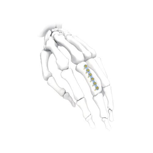 Компрессионная костная пластина для кисти руки - PNM5002 - NORMMED Medical Devices - блокируемая / металлическая