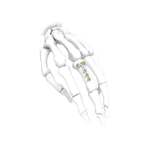 Компрессионная костная пластина для кисти руки - PNM5004 - NORMMED Medical Devices - блокируемая / металлическая