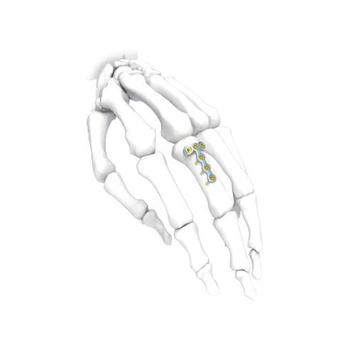 Компрессионная костная пластина для кисти руки - T - NORMMED Medical Devices - блокируемая / металлическая