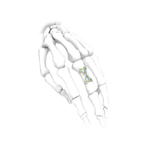 Компрессионная костная пластина для кисти руки - PNM5006-022 - NORMMED Medical Devices - блокируемая / металлическая