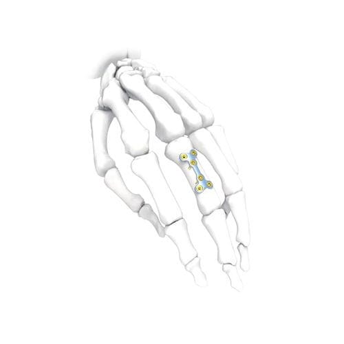 Компрессионная костная пластина для кисти руки - PNM5006-032 - NORMMED Medical Devices - блокируемая / металлическая