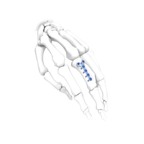 Компрессионная костная пластина для кисти руки - Y  - NORMMED Medical Devices - блокируемая / металлическая