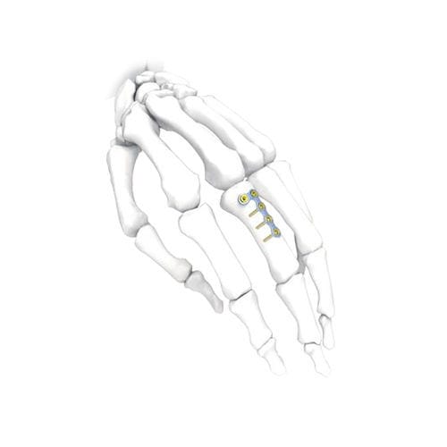 Компрессионная костная пластина для кисти руки - L  - NORMMED Medical Devices - блокируемая / металлическая