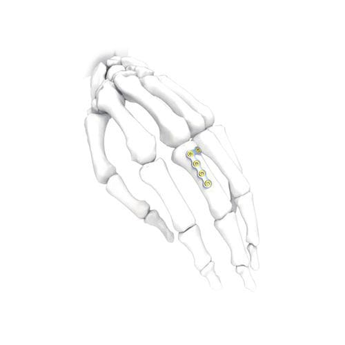 Компрессионная костная пластина для кисти руки - NORMMED Medical Devices - блокируемая / металлическая