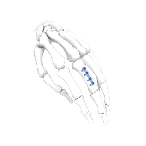 Компрессионная костная пластина для кисти руки - NORMMED Medical Devices - ступня / блокируемая / металлическая