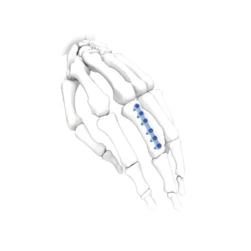 Компрессионная костная пластина для кисти руки - Long - NORMMED Medical Devices - ступня / блокируемая / металлическая