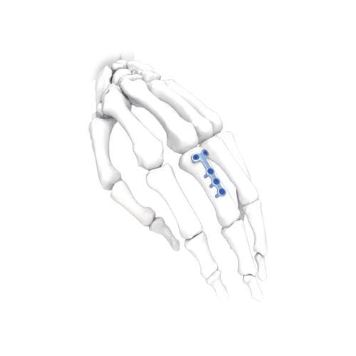 Компрессионная костная пластина для кисти руки - T - NORMMED Medical Devices - ступня / блокируемая / металлическая