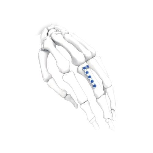 Компрессионная костная пластина для кисти руки - PNM5012-100 - NORMMED Medical Devices - ступня / блокируемая / металлическая