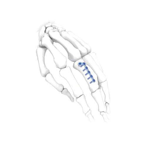 Компрессионная костная пластина для кисти руки - L Oblique  - NORMMED Medical Devices - ступня / блокируемая / металлическая
