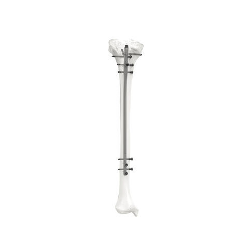 Интрамедуллярный штифт большеберцовая кость - PNM3308 - NORMMED Medical Devices - диафизарная фиксация / проксимальная фиксация / металлический