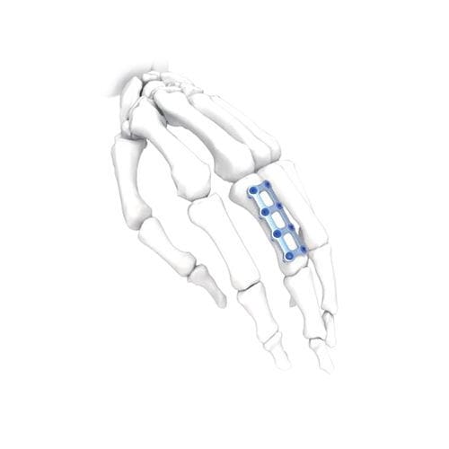 Компрессионная костная пластина для кисти руки - Mini  - NORMMED Medical Devices - блокируемая / металлическая