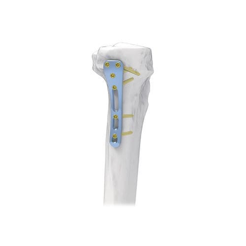 Компрессионная костная пластина большеберцовая кость - NORMMED Medical Devices - проксимальная / заднемедиальная / блокируемая