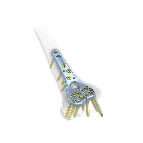Компрессионная костная пластина лучевая кость - NORMMED Medical Devices - дистальная / блокируемая / металлическая