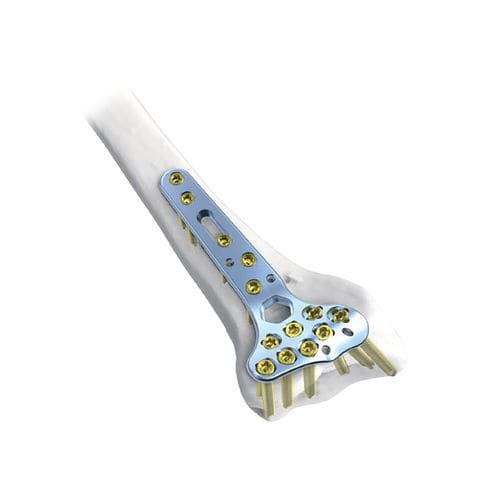 Компрессионная костная пластина лучевая кость - Rim  - NORMMED Medical Devices - дистальная / блокируемая / металлическая
