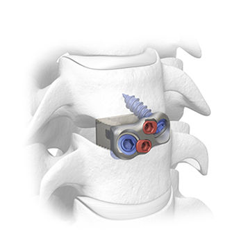 Межтеловой кейдж шеи - Ceres®-C - SPINAL elements - через передний отдел / из ПЭЭК / с костной пластиной шейного отдела