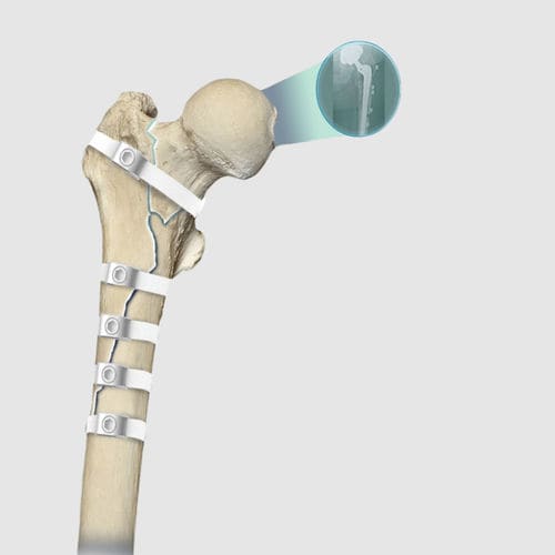 Ортопедическая проволока для контроля протеза бедра - Ortholox® UHMWPE - Ortolog Medikal - полимерная комплексная нить