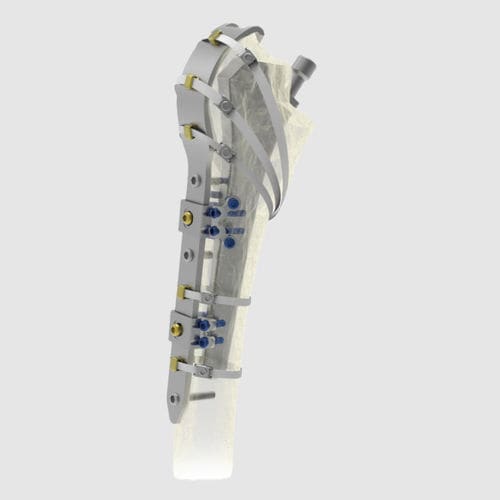 Компрессионная костная пластина для перипротезного перелома бедра - Ortholox®  - Ortolog Medikal - проксимальная / блокируемая / из титана