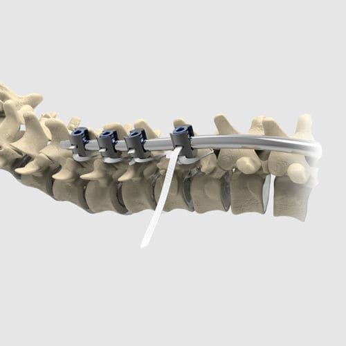 Педиатрическое спинномозговое крепление для задней фиксации - Ortholox&reg; UHMWPE - Ortolog Medikal