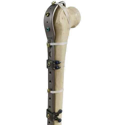 Компрессионная костная пластина для перипротезного перелома бедра - Ortholox®  - Ortolog Medikal - проксимальная / дистальная / блокируемая