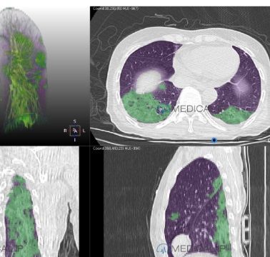 Программное обеспечение для анализа изображений - MEDIP Pneumovid - MEDICALIP Co., Ltd. - для визуализации / с системой отслеживания / TDM