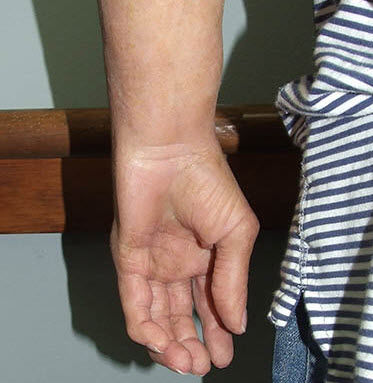 Эстетический протез кисти руки - Medical Art Prosthetics - для взрослых