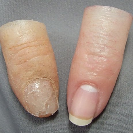 Эстетический протез пальца - Medical Art Prosthetics - для взрослых