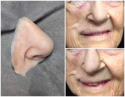 Эстетический протез для носа - lifelike  - Medical Art Prosthetics - для взрослых