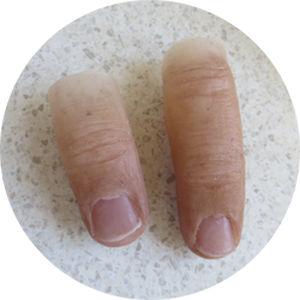 Эстетический протез пальца - Northern Prosthetics - для взрослых