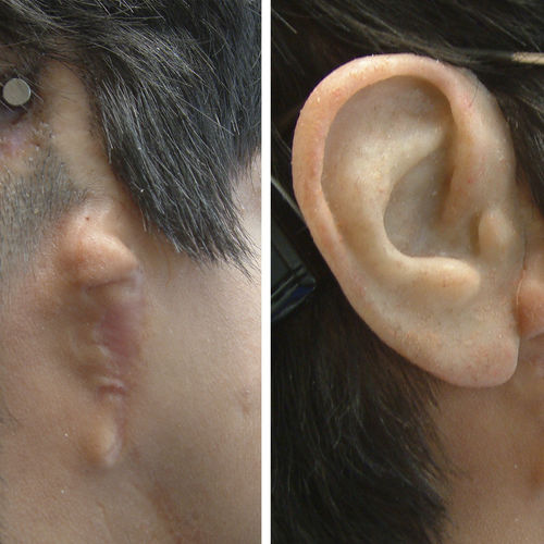 Ушной эстетический протез - Prosthetic Artists - для взрослых