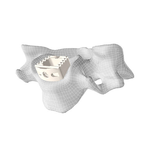 Межтеловой кейдж шеи - CL5™ - Corelink Surgical - через передний отдел / из ПЭЭК