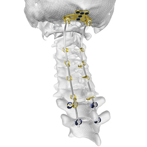 Затылочно-шейно-грудная система остеосинтеза - TIGER® - Corelink Surgical - через задний отдел