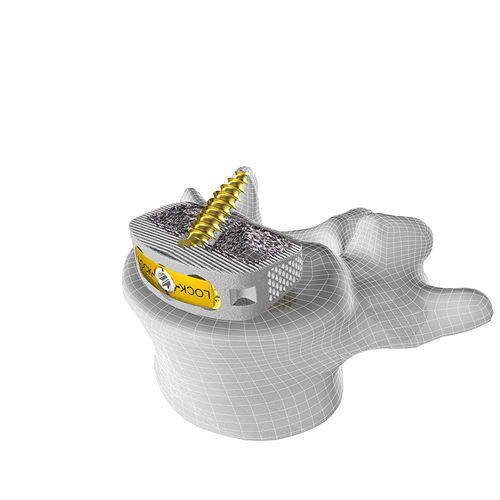 Межтеловой кейдж для поясничной зоны - M3 STAND-ALONE ALIF - Corelink Surgical - через передний отдел