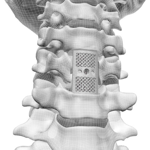 Позвоночный протез шеи - F3D - Corelink Surgical - изготовленный методом 3D-печати