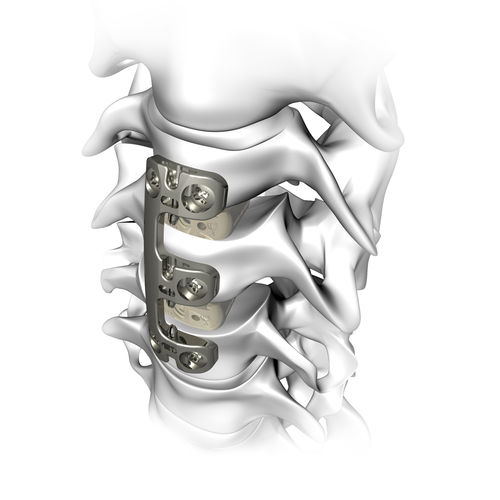 Костная пластина для артродеза шеи - VERTEVIEW - Atlas Spine - блокируемая / металлическая / 2 уровня
