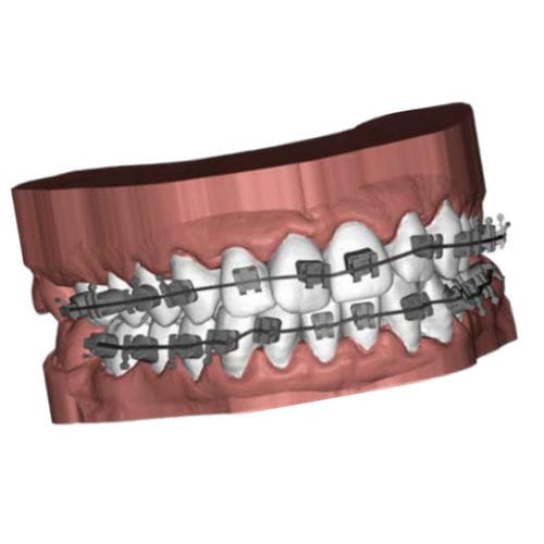 Программное обеспечение CAO - Ubrackets - Coruo - для печати 3D / ортодонтическое / Windows