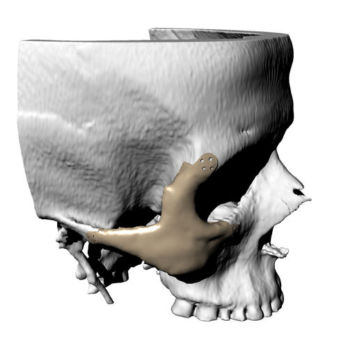 Имплантат параорбитальной области на заказ - Kune Implants - нерассасывающийся