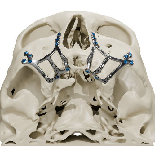 Субпериостальный имплантат по индивидуальному заказу - Craniotech - из титана / анатомический / субпериостальный