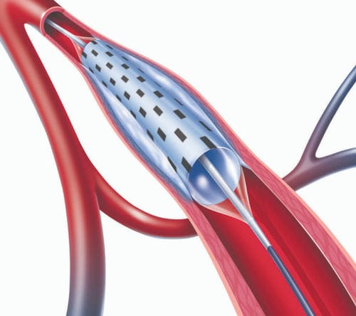 Катетер PTA - PolarCath  - Nucryo Vascular - подколенная артерия / бедренная артерия / подвздошная артерия