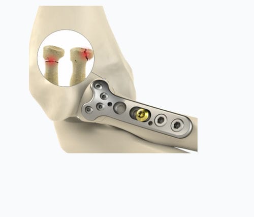 Компрессионная костная пластина лучевая кость - 8762 series - Zimed Medical - для головки лучевой кости / проксимальная / блокируемая