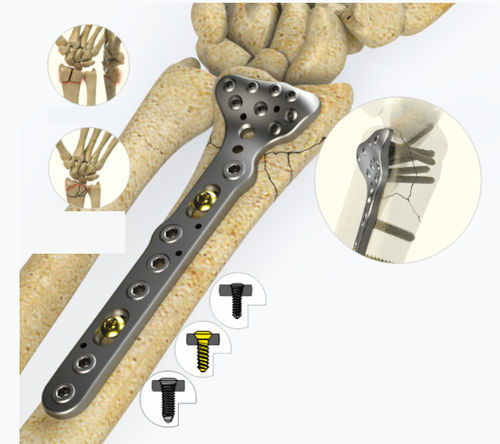 Компрессионная костная пластина лучевая кость - 1442 series - Zimed Medical - дистальная / блокируемая / металлическая