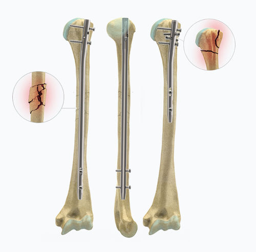 Интрамедуллярный штифт плечевая кость - 4102 series - Zimed Medical - металлический