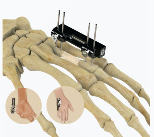 Внешний фиксатор пястно-фаланговый сустав - 5084 series - Zimed Medical - трубчатый