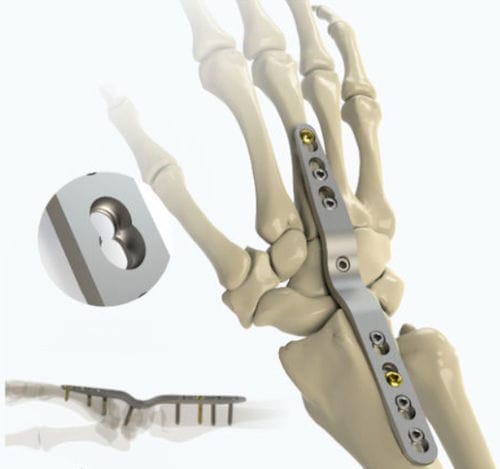 Костная пластина для артродеза для лучезапястного сустава - 1022-0008 - Zimed Medical - блокируемая / металлическая