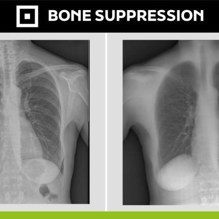Медицинское программное обеспечение - Bone Suppression - Digitec - рентгенографии / для диагностики / для постобработки
