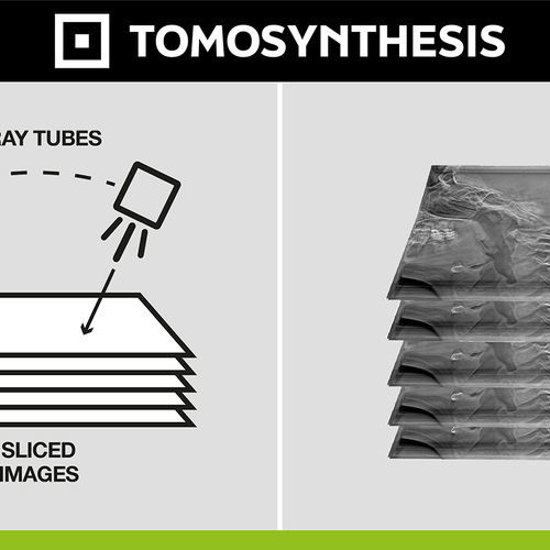 Медицинское программное обеспечение - Digital Tomosynthesis - Digitec - рентгенографии / для диагностики / для постобработки