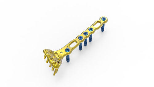 Компрессионная костная пластина для запястья - TRUE LOCK  - Truemed Medical - дистальная / блокируемая / металлическая