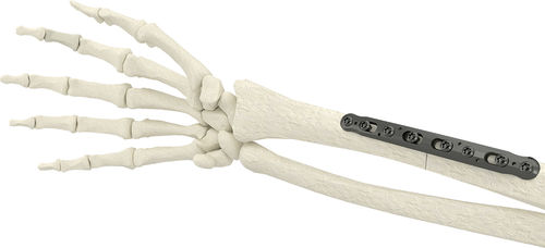 Компрессионная костная пластина лучевая кость - PK-SCP2704-TI - WishBone Medical - медиальная / металлическая / педиатрическая