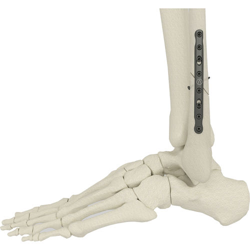 Костная пластина для остеотомии малоберцовая кость - PK-SFP series - WishBone Medical - медиальная / неблокируемая / металлическая