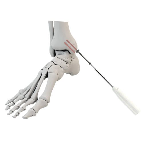 Артродезный винт для лодыжки - WishBone Medical - канюлированный / из титана / кортикальный